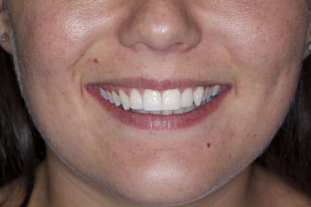 Inman Aligner Sharrow Vale Dental Care