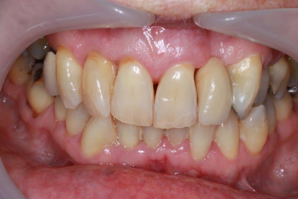 After dental bridge
