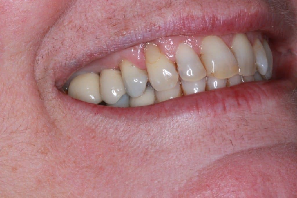 after dental implants