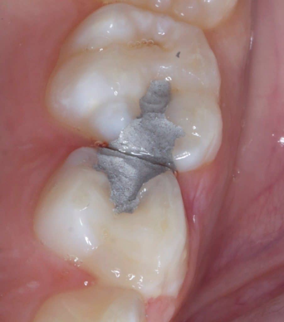 amalgam filling