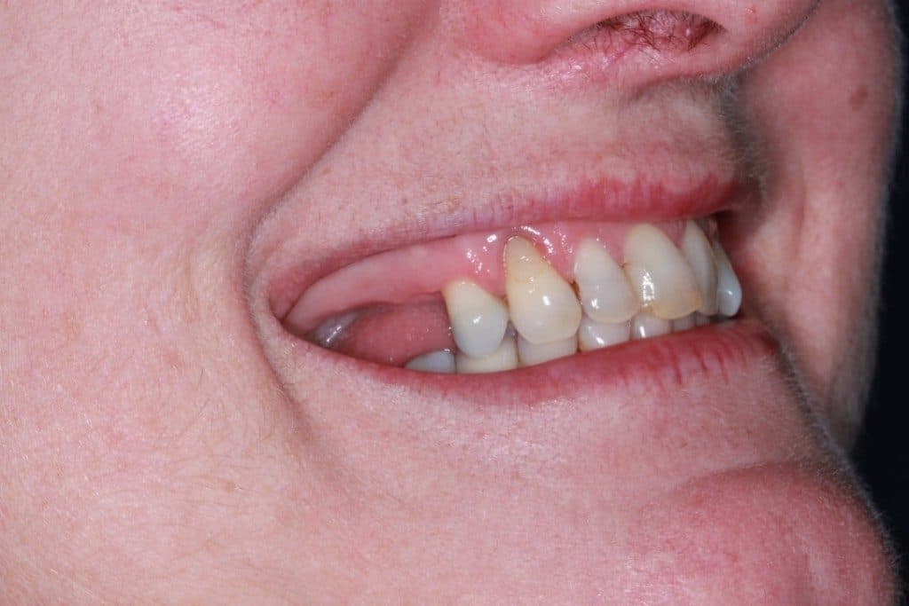 before dental implants