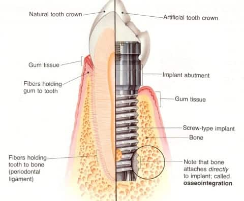 Implant Dentistry