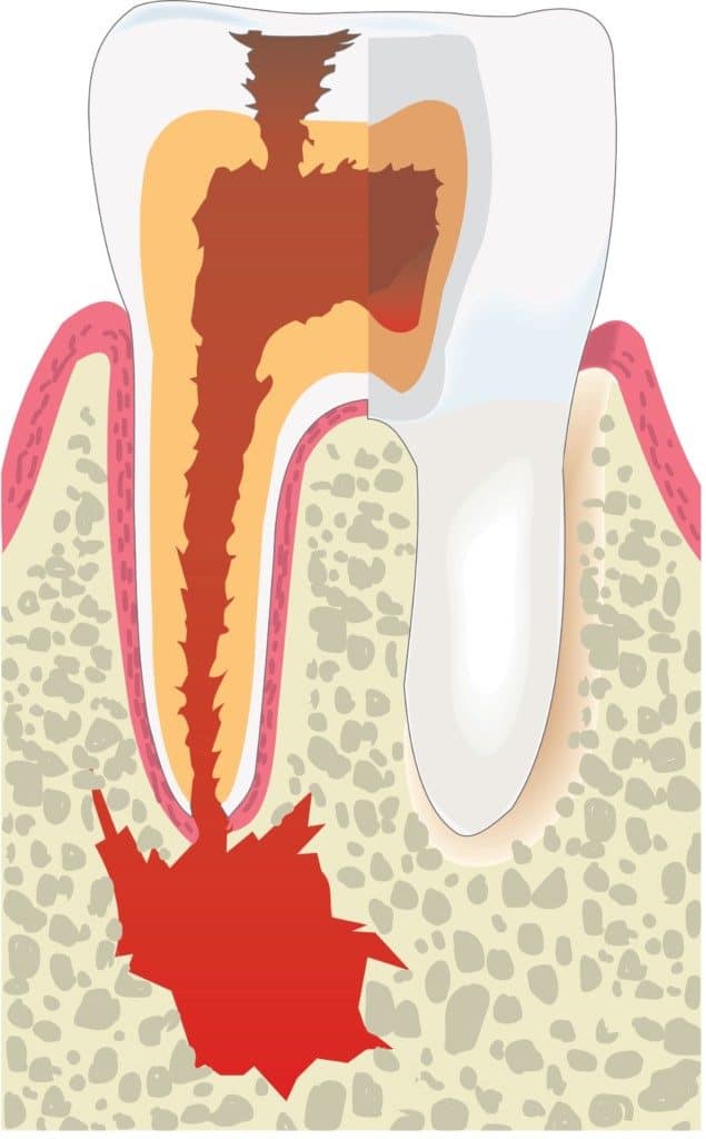 Root canal treatment