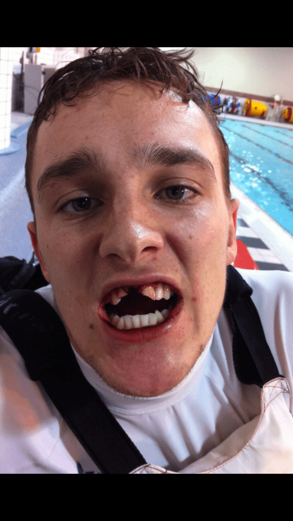 Mouthguards Sharrow Vale Dental Care