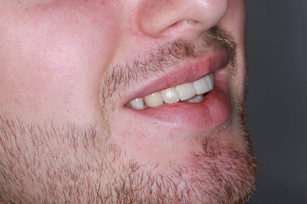 Invisalign After
