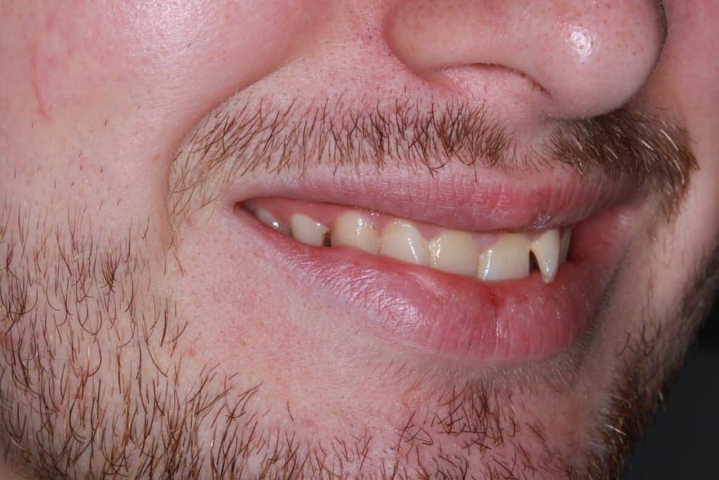 Invisalign Before