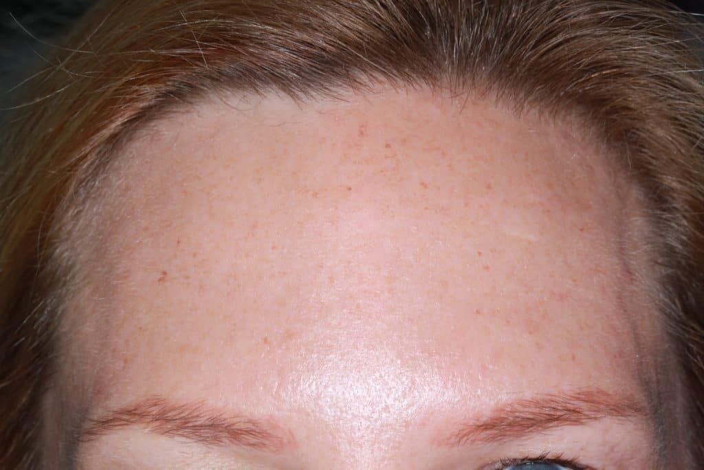 lines and wrinkles before