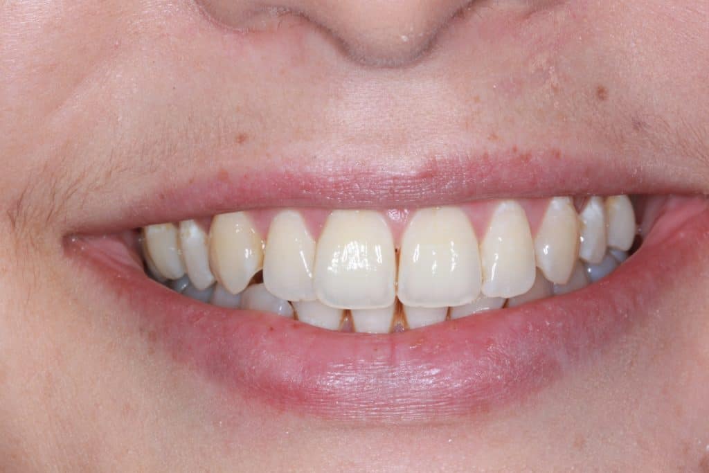 Before teeth whitening