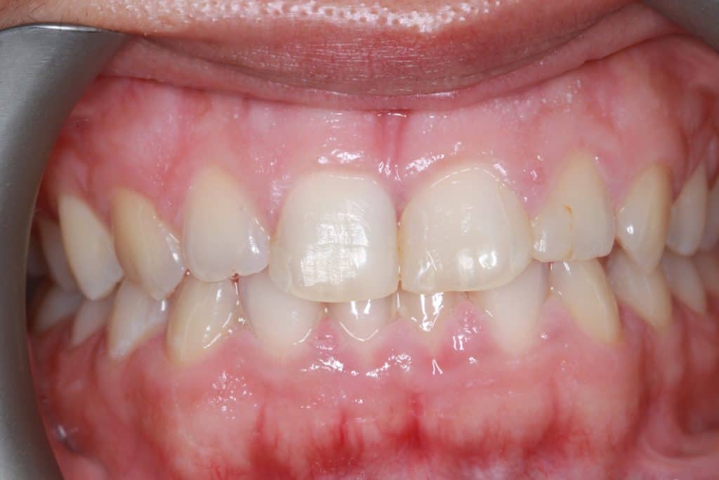 Before dental veneers