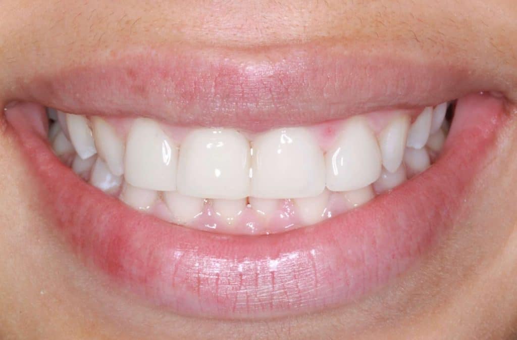 After dental veneers