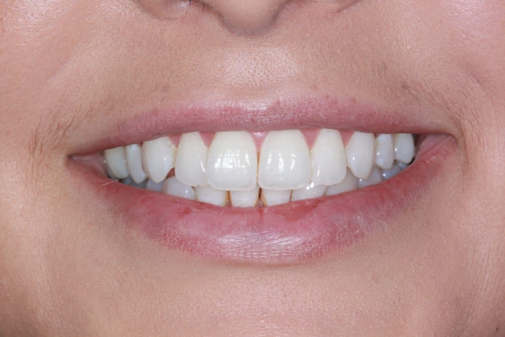 After teeth whitening