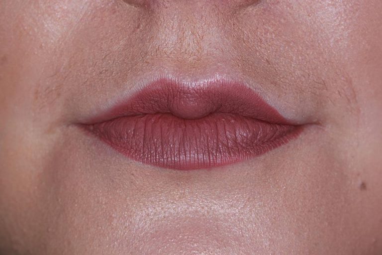 Lips after dermal fillers