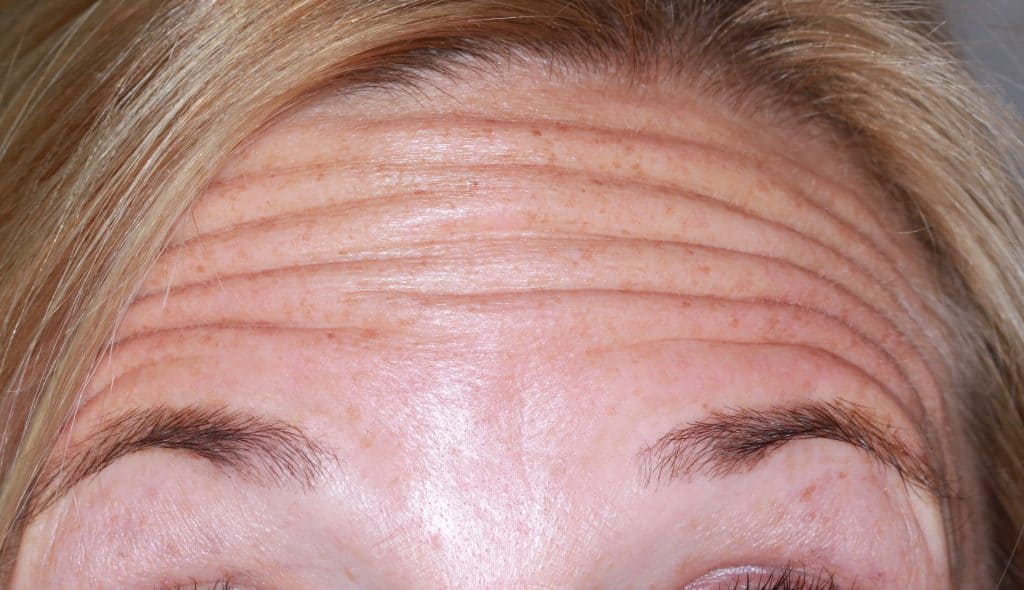 lines and wrinkles before