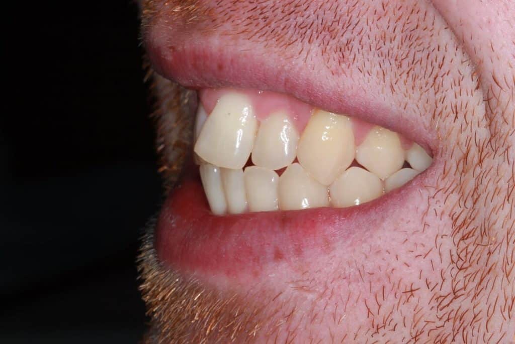 invisalign before