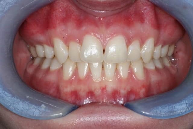 Invisalign Before