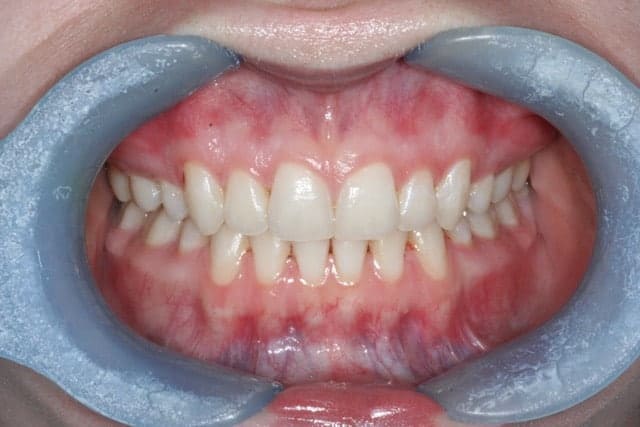 Invisalign After
