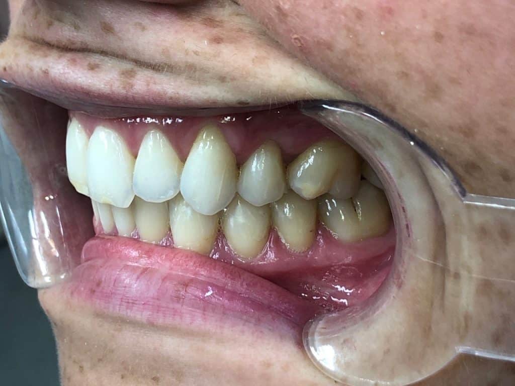 After Invisalign