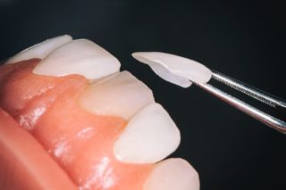 Example dental porcelain veneer