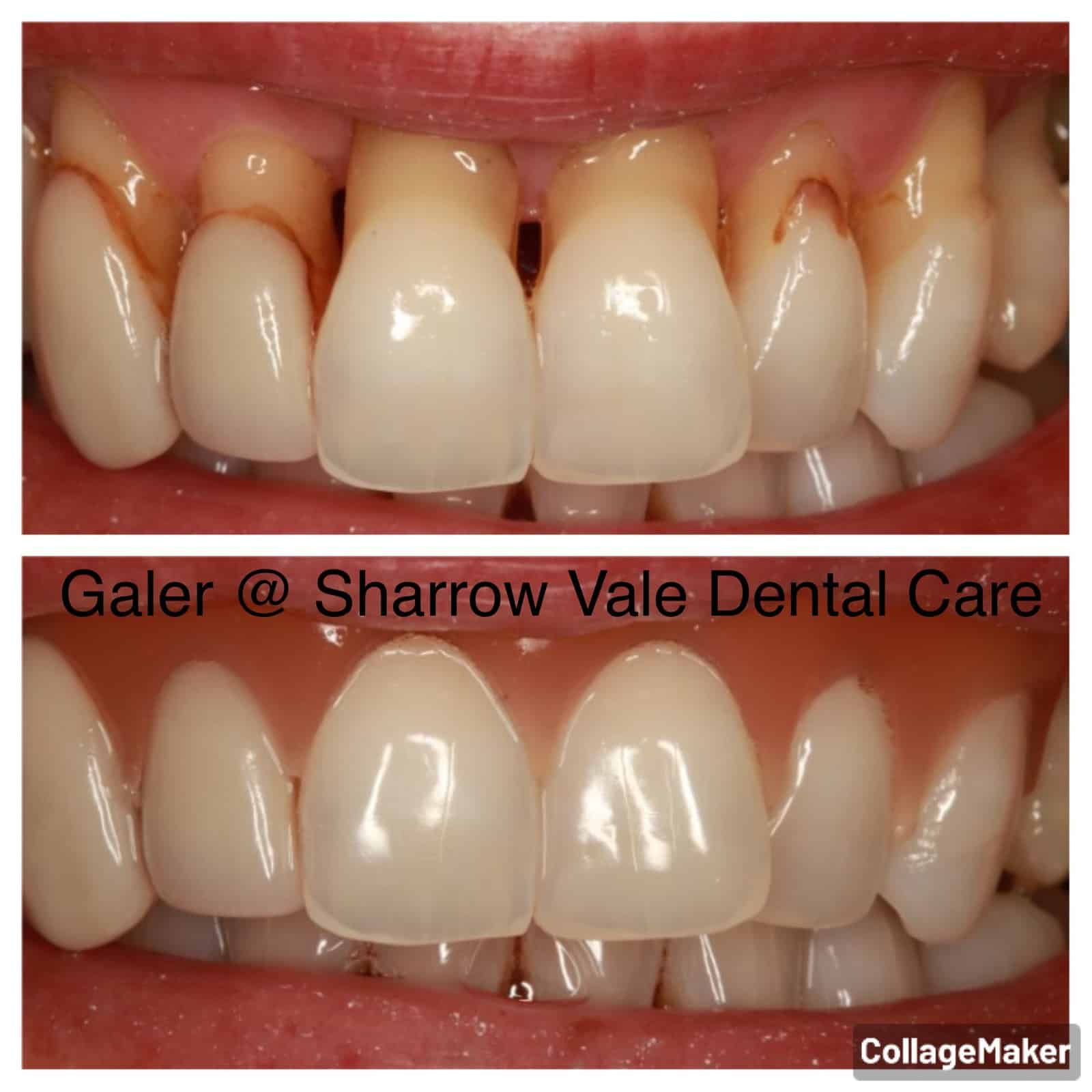 Gingival veneer Sharrow Vale Dental Care